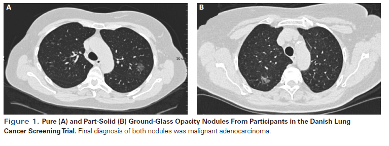Ground-Glass Opacity Lung Nodules in the Era of Lung Cancer CT Screening:  Radiology, Pathology, and Clinical Management