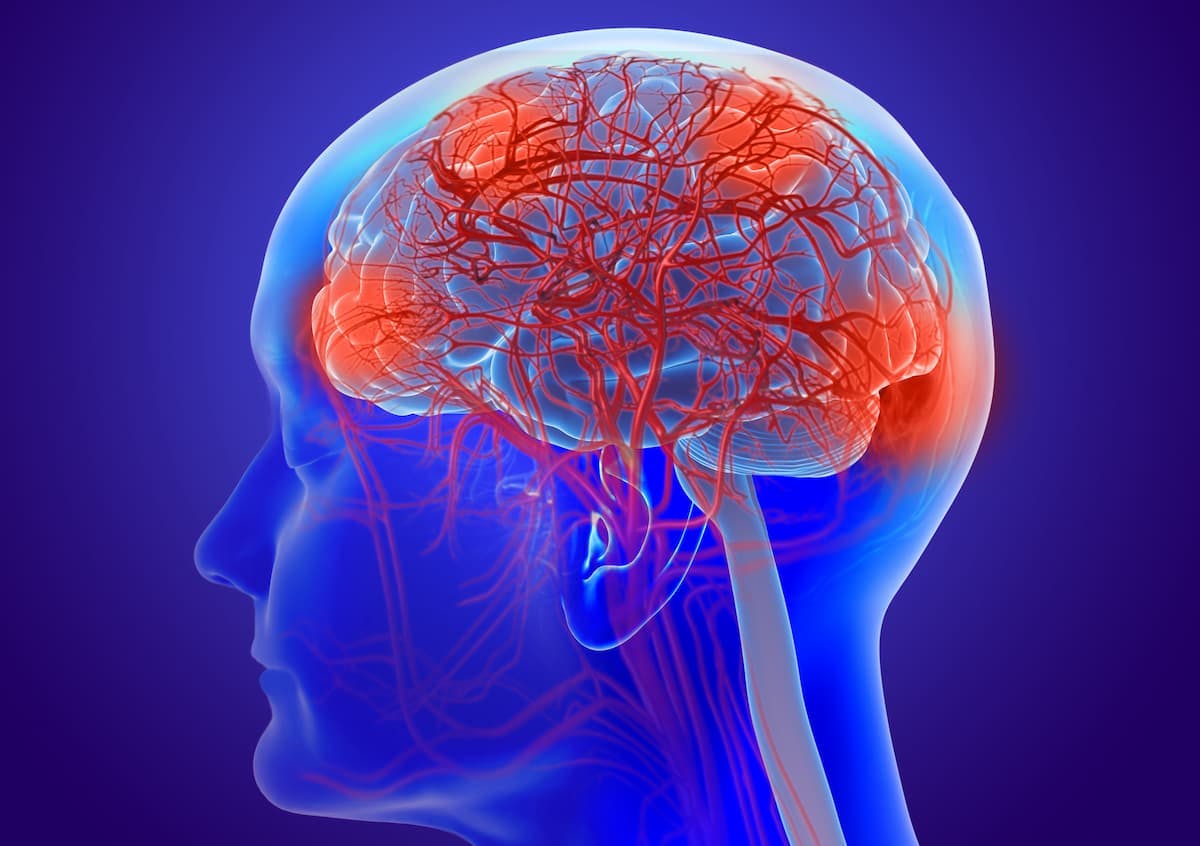 Low-Dose Lenalidomide Demonstrates Activity in Adolescents With Glioma 
