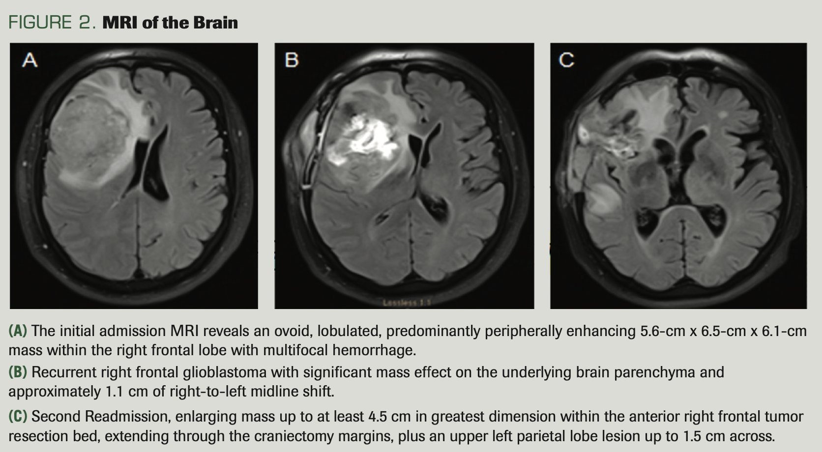 FIGURE 2. MRI of the Brain