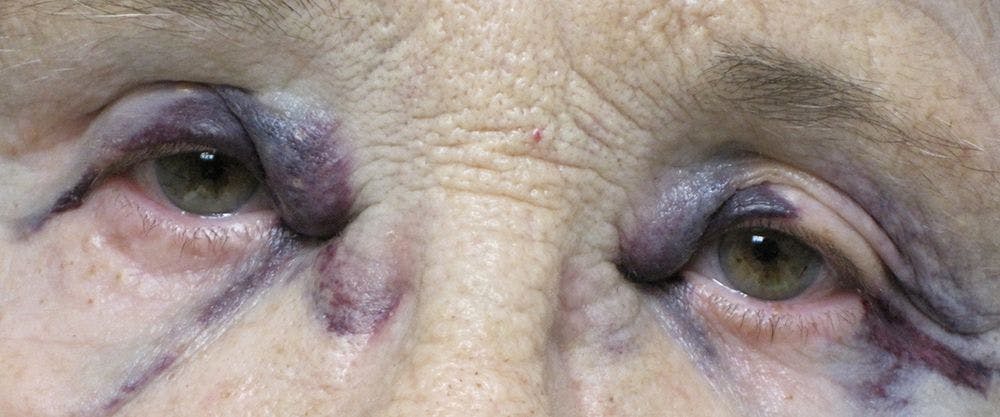 A 78-Year-Old Woman With Nonpruritic Periorbital Purpura Around Her Eyelids