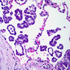 Pattern in Lung Cancer Pathology May Predict Recurrence Risk