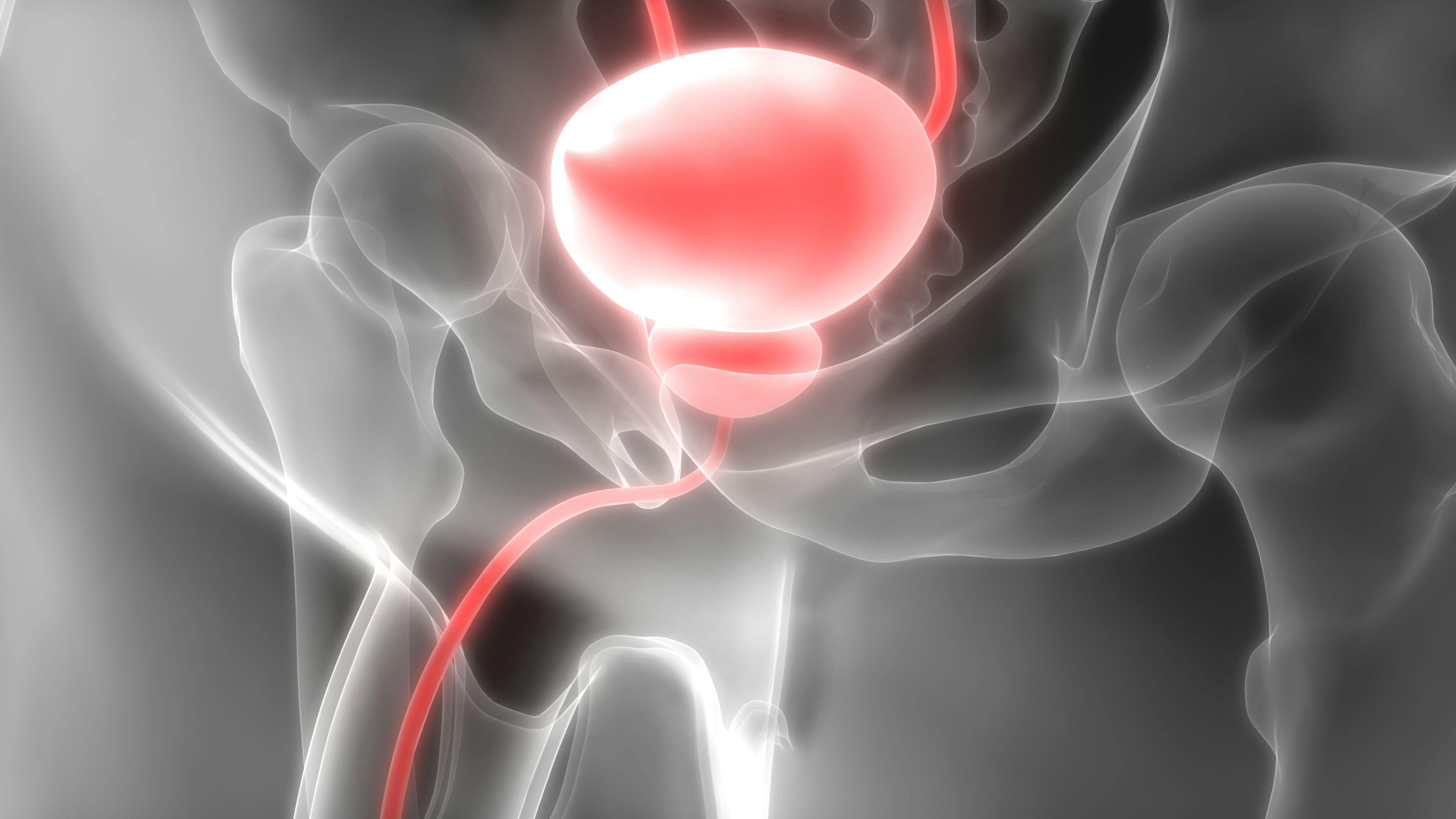 Findings from the phase 3 PRESTO trial indicated that patients with high-risk biochemically recurrent prostate cancer may derive benefit from treatment with androgen deprivation therapy intensification and apalutamide.