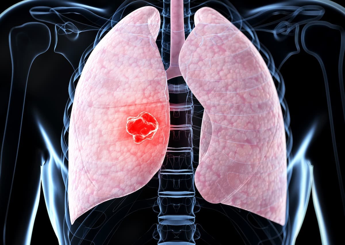Sotorasib maintains a progression-free survival benefit compared with docetaxel in the treatment of patients with KRAS G12C-mutated non–small cell lung cancer in the phase 3 CodeBreaK 200 trial. 