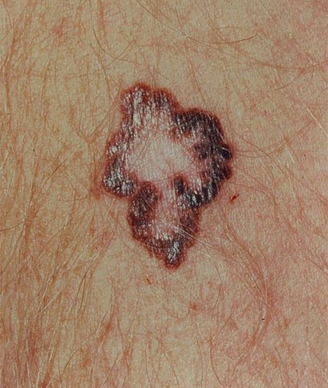 Melanoma with characteristic asymmetry, border irregularity, color variation, an