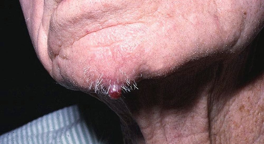 A 71-Year-Old Male Presents for Evaluation of Painless Bump on His Chin