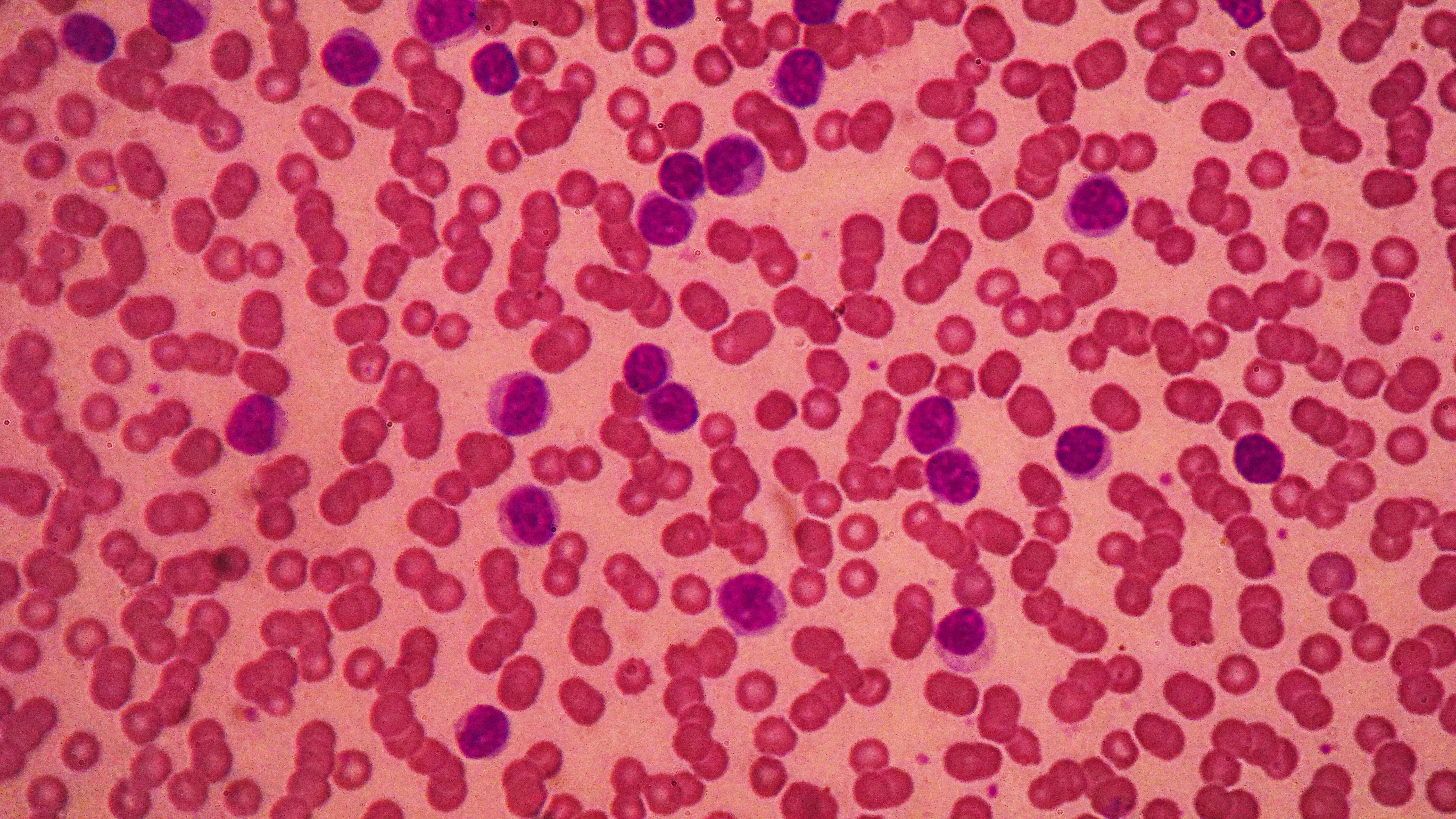 “A single administration of liso-cel demonstrated rapid, deep, and durable responses in patients with relapsed/refractory chronic lymphocytic leukemia and small lymphocytic lymphoma,” Tanya Siddiqi, MD, lead study author and medical director in the Division of Lymphoma at City of Hope Orange County in Duarte California, said.