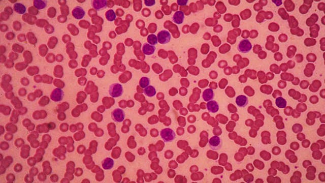Moxetumomab pasudotox-tdfk, approved as a treatment for relapsed/refractory hairy cell leukemia in 2018, will be withdrawn from the United States market in July 2023.