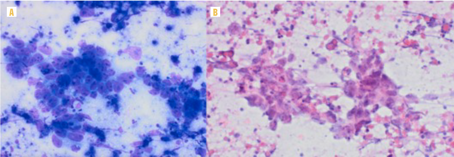 FIGURE 3. Staining Results (A) Diff-Quik stain (×20): Pleomorphic malignant cells with large irregular nuclei, coarse chromatin, prominent irregular nucleoli, vacuolated cytoplasm, and indistinct cell borders (syncytial growth pattern). (B) Papanicolaou stain (×20): Syncytial cluster of pleomorphic malignant cells with coarse chromatin and prominent nucleoli in a background of necrotic debris.