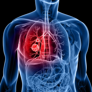 "Adjuvant alectinib represents an important efficacious new treatment strategy for patients with resected ALK-positive NSCLC of stage IB, II, or IIIA," according to the study authors.