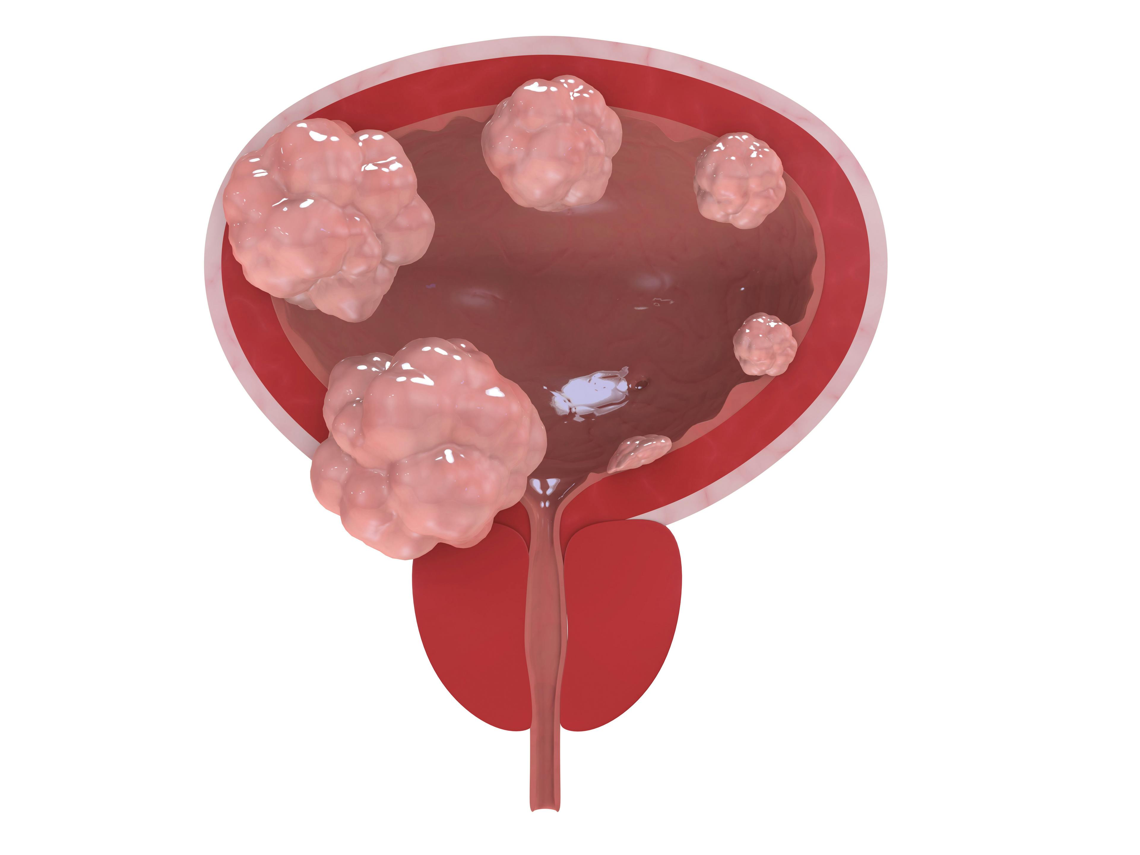 Investigators identify an association between circulating tumor DNA in the blood plasma detected via the RaDaR assay and response to treatment with neoadjuvant immunotherapy for muscle-invasive bladder cancer.