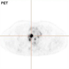 PET scan of a Hodgkin lymphoma