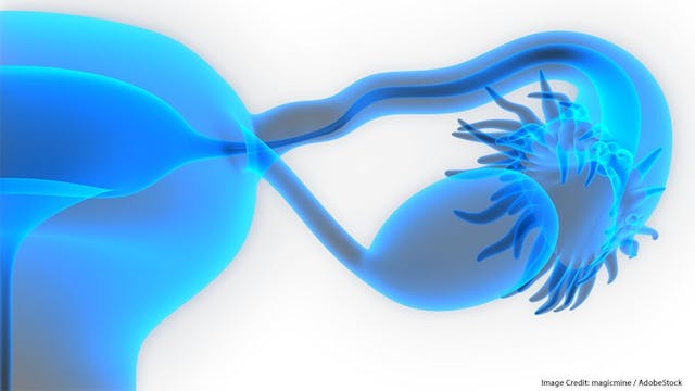 Dose Modification of Maintenance Niraparib May Not Impact PFS in Ovarian Cancer | Image Credit: © magicmine - stock.adobe.com. 