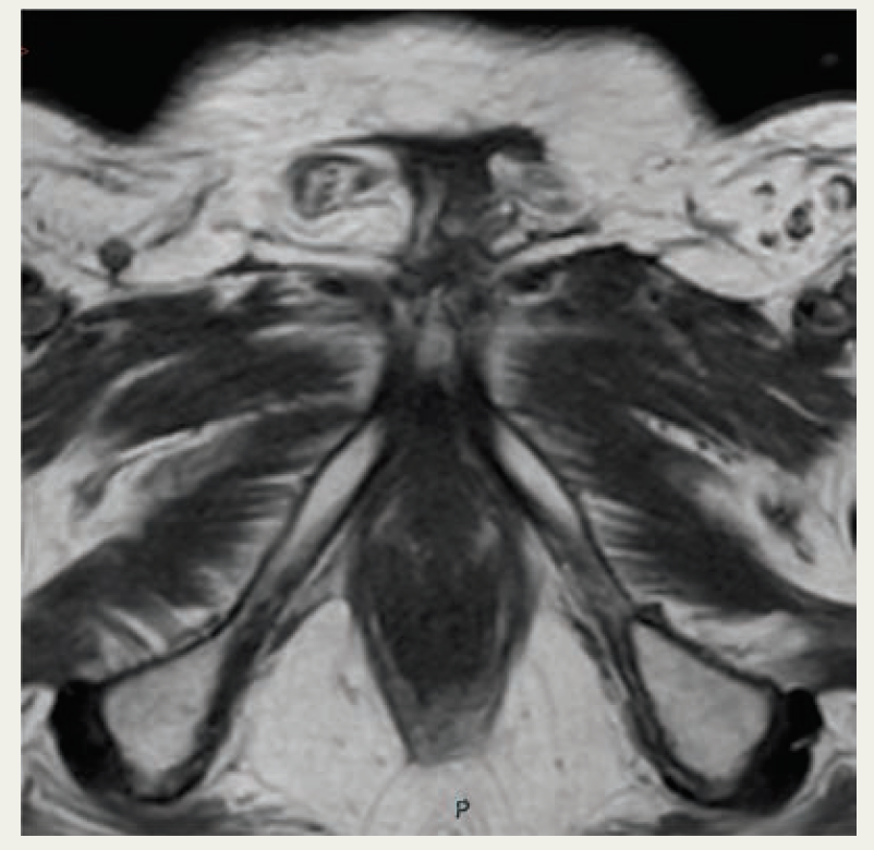 FIGURE 3. MRI From Most Recent Follow-Up at 2 Years, Demonstrating No Disease