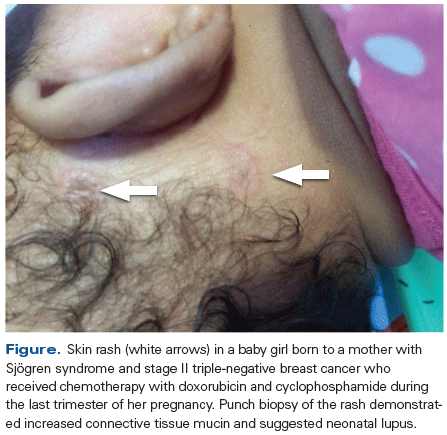 Chemotherapy for Breast Cancer During Pregnancy, With Neonatal Lupus in the Newborn