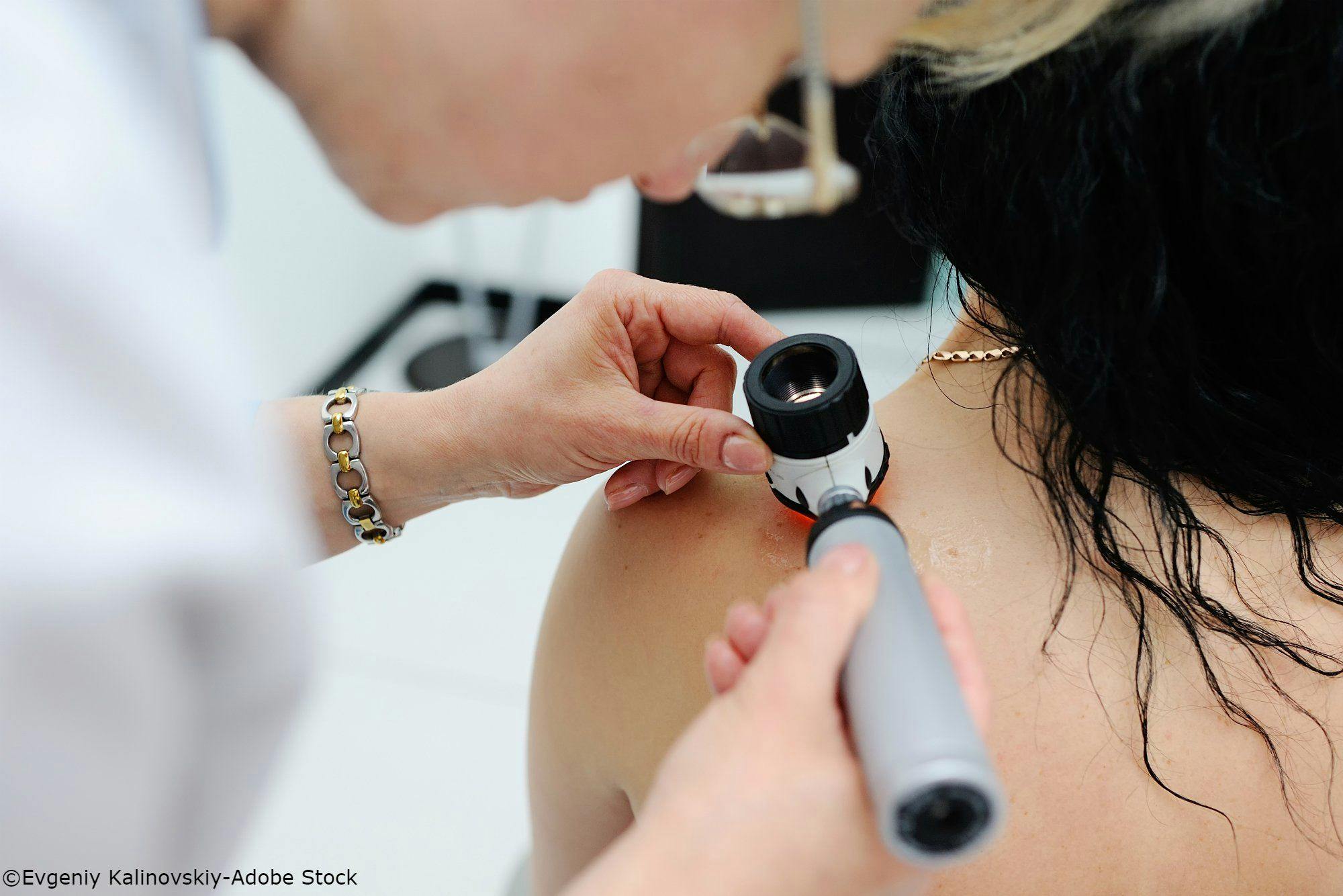 New Guidelines for Early-Stage Melanoma Treatment