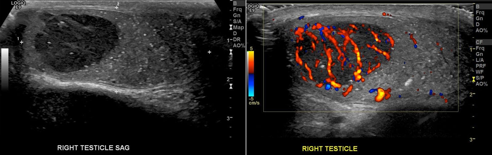 Palpable Nodule in Testicle of Young Man