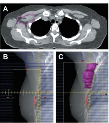 The Use of Surgery and Radiotherapy as Treatment of Regional Nodes in Breast Cancer Patients