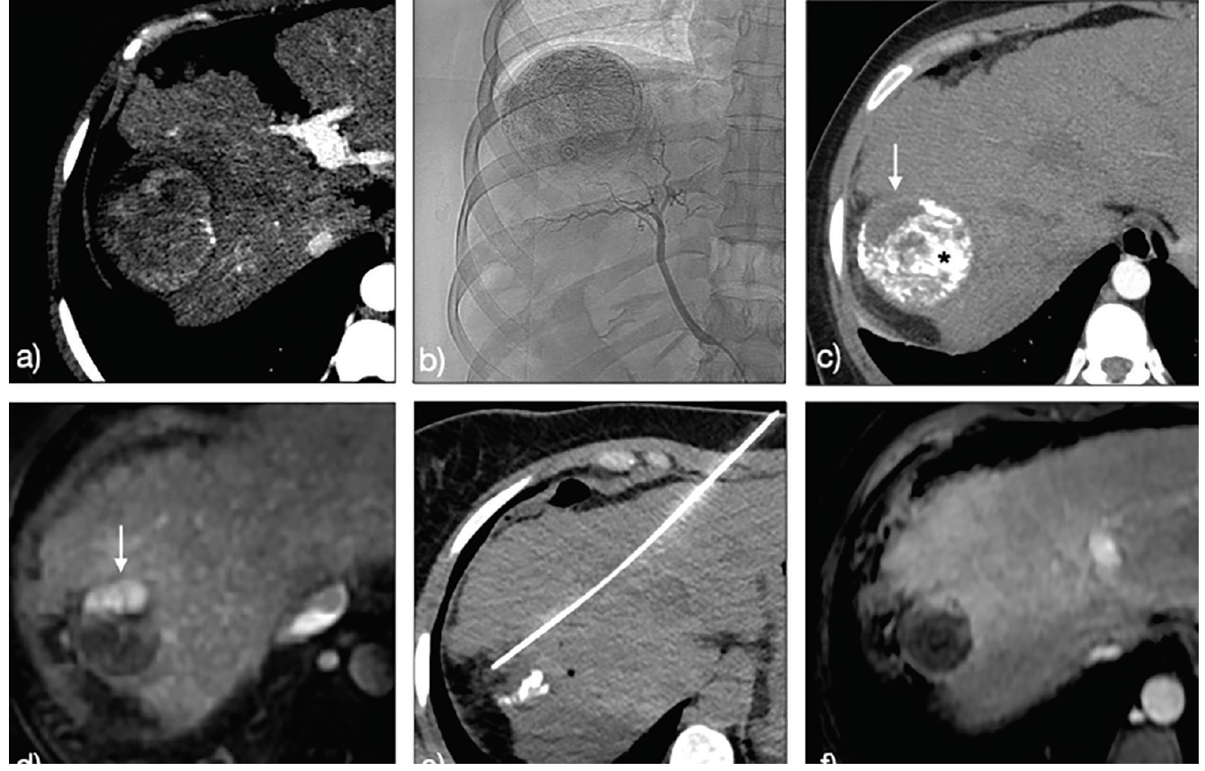 How to Radiologically Assess and Follow Response After Treatment of Hepatocellular Carcinoma 