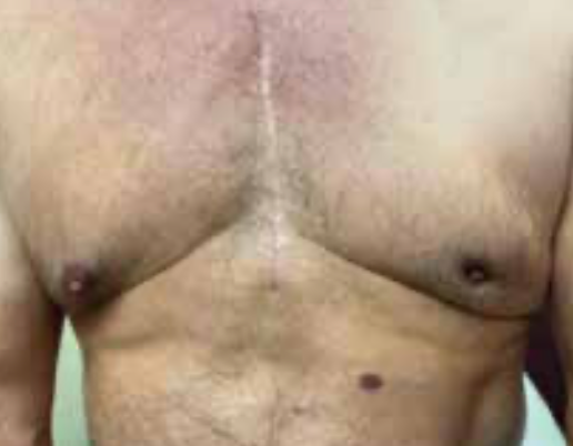 FIGURE 1. Left breast mass with retraction of retro areolar and nipple region without discharge.