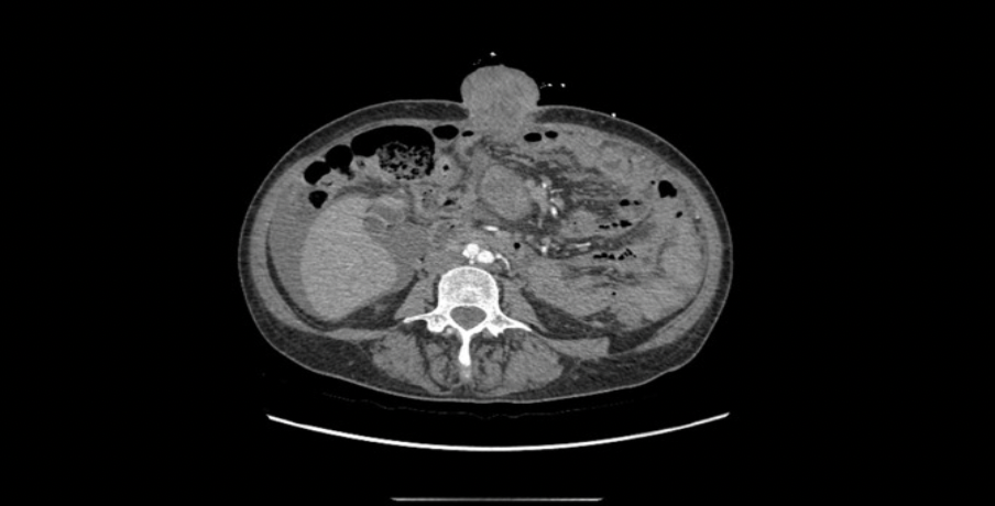 Extreme Case of Surgical Port Metastasis in Ovarian Cancer