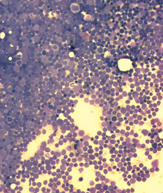 Acute lymphoblastic leukemia smear