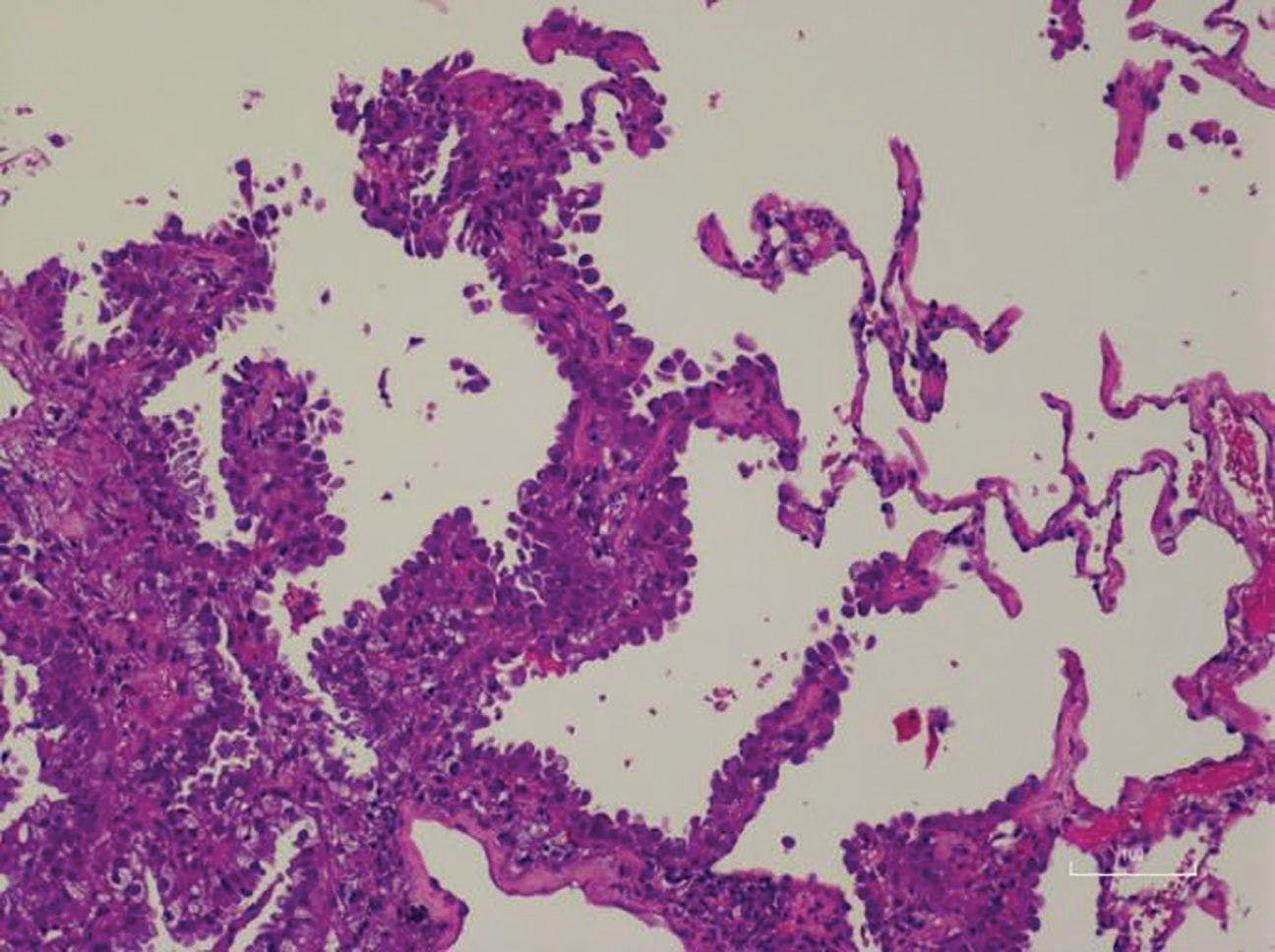 A Patient With Newly Diagnosed, Advanced EGFR-Mutated Non–Small Cell Lung Cancer