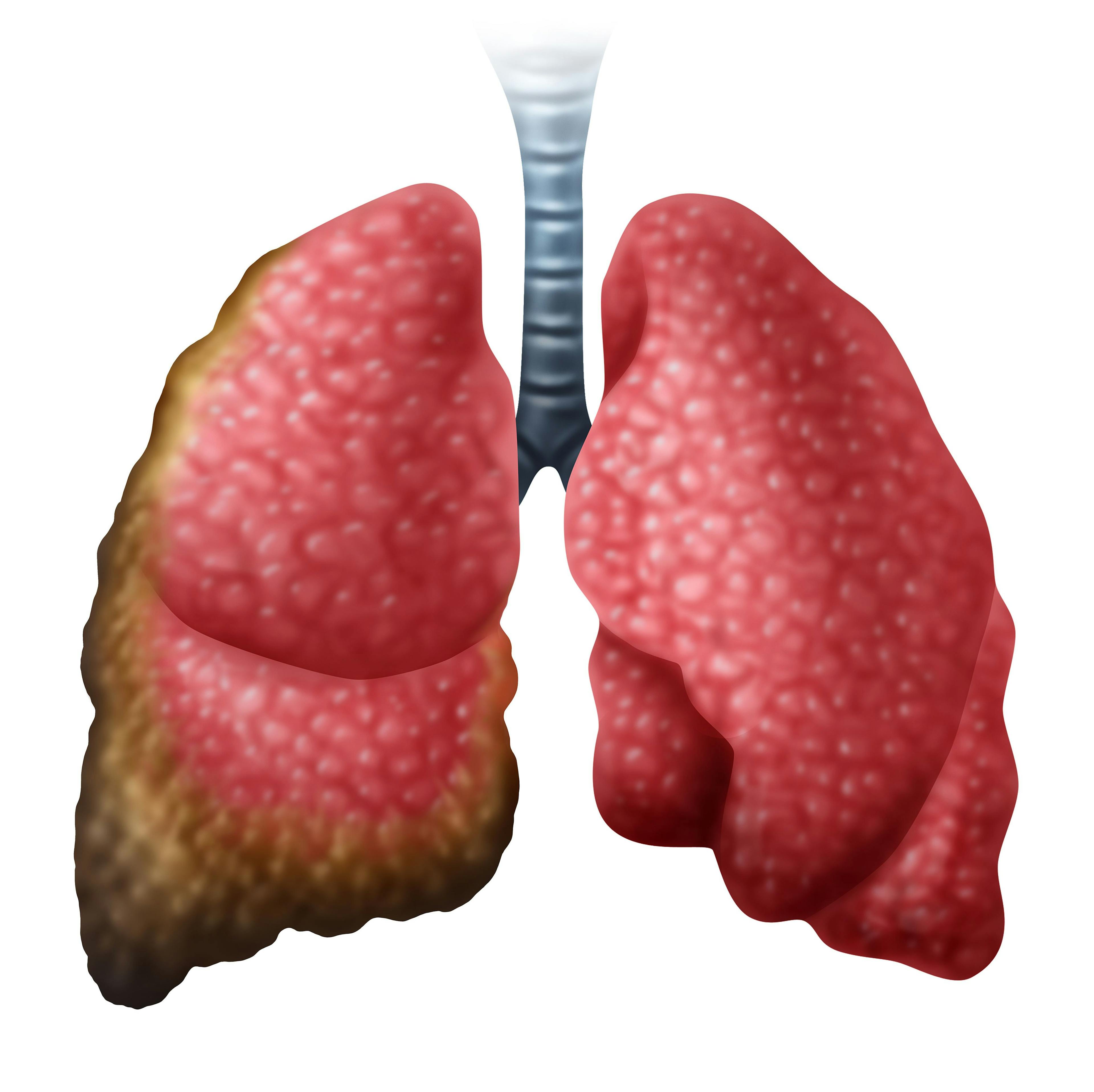 FDA Approves Immunotherapy Combination for Previously Untreated Unresectable Malignant Pleural Mesothelioma
