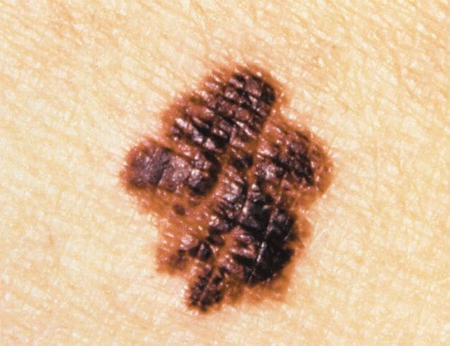 Criteria Identified to Select Melanoma Patients for Sentinel Lymph Node Biopsy