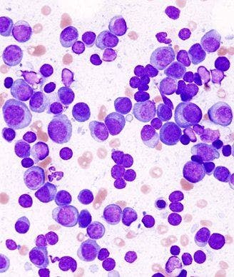 Carfilzomib Triplet Fails to Induce Superior PFS in Newly Diagnosed Multiple Myeloma