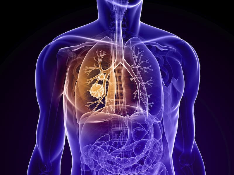 Favorable Responses Derived From Trastuzumab Deruxtecan in HER2+ NSCLC