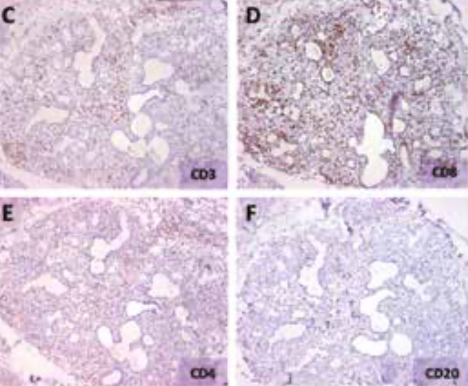 Sjögren Syndrome Induced by Immune Checkpoint Inhibitors in a Patient with Advanced Renal Cell Carcinoma