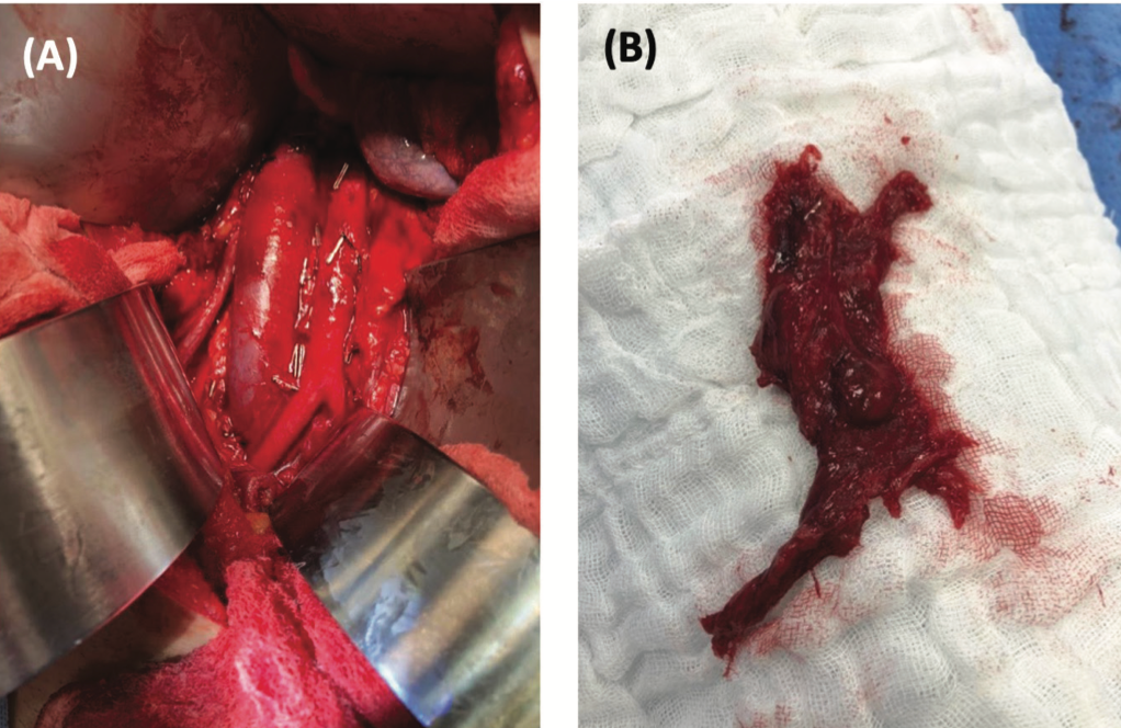 FIGURE 2. Bilateral Nerve-Sparing Retroperitoneal Lymph Node Dissection (RPLND) (A) Retroperitoneal view of the intraoperative site after nerve-sparing RPLND. (B) Surgical specimen of resected residual disease.