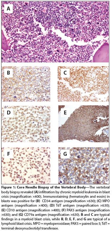 Biphenotypic Extramedullary Blast Crisis of Chronic Myeloid Leukemia With Variant Philadelphia Chromosome Translocation