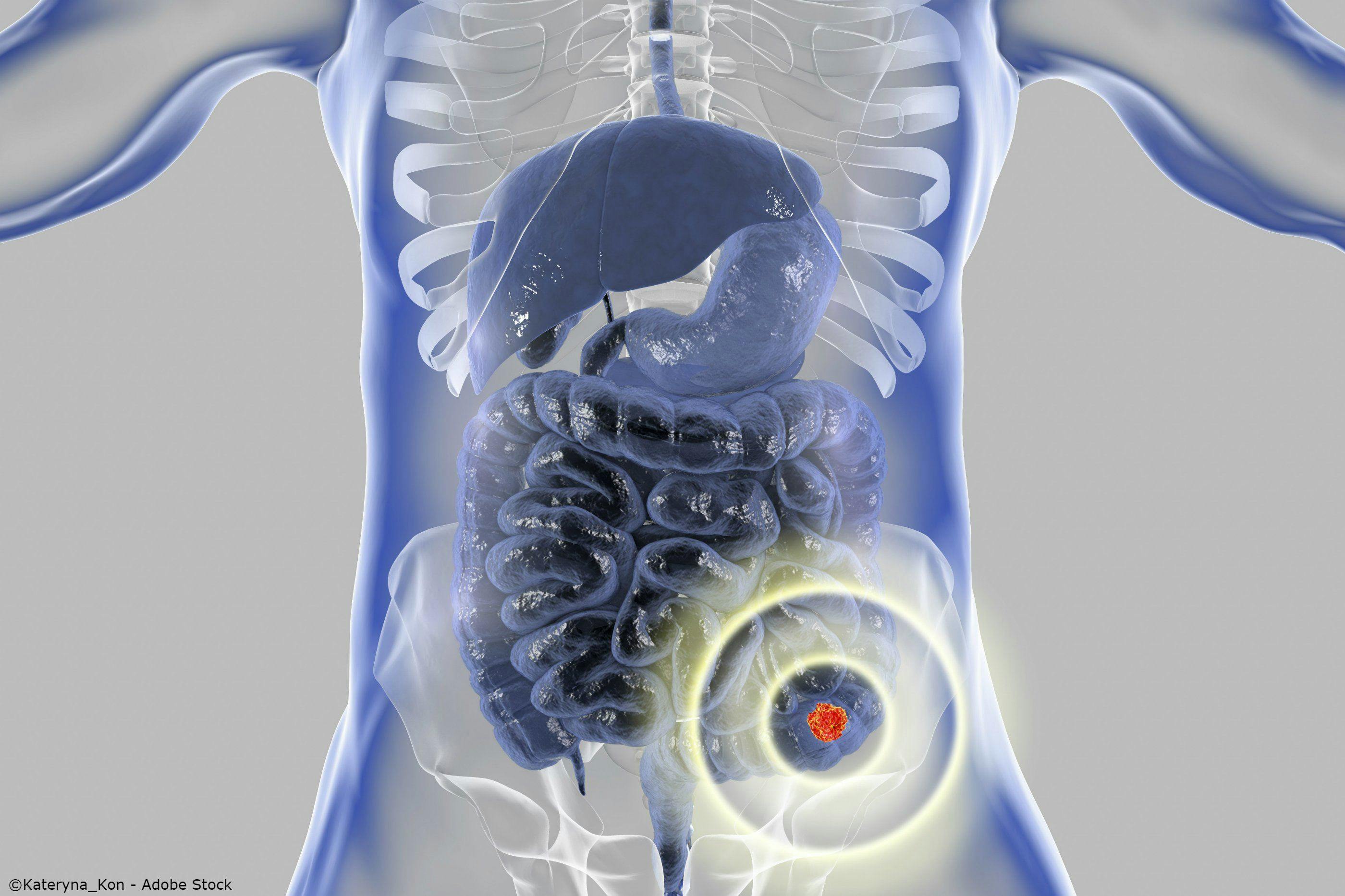 Molecular Testing Lends Knowledge to Mutation Profile in Patients with Colorectal Cancer