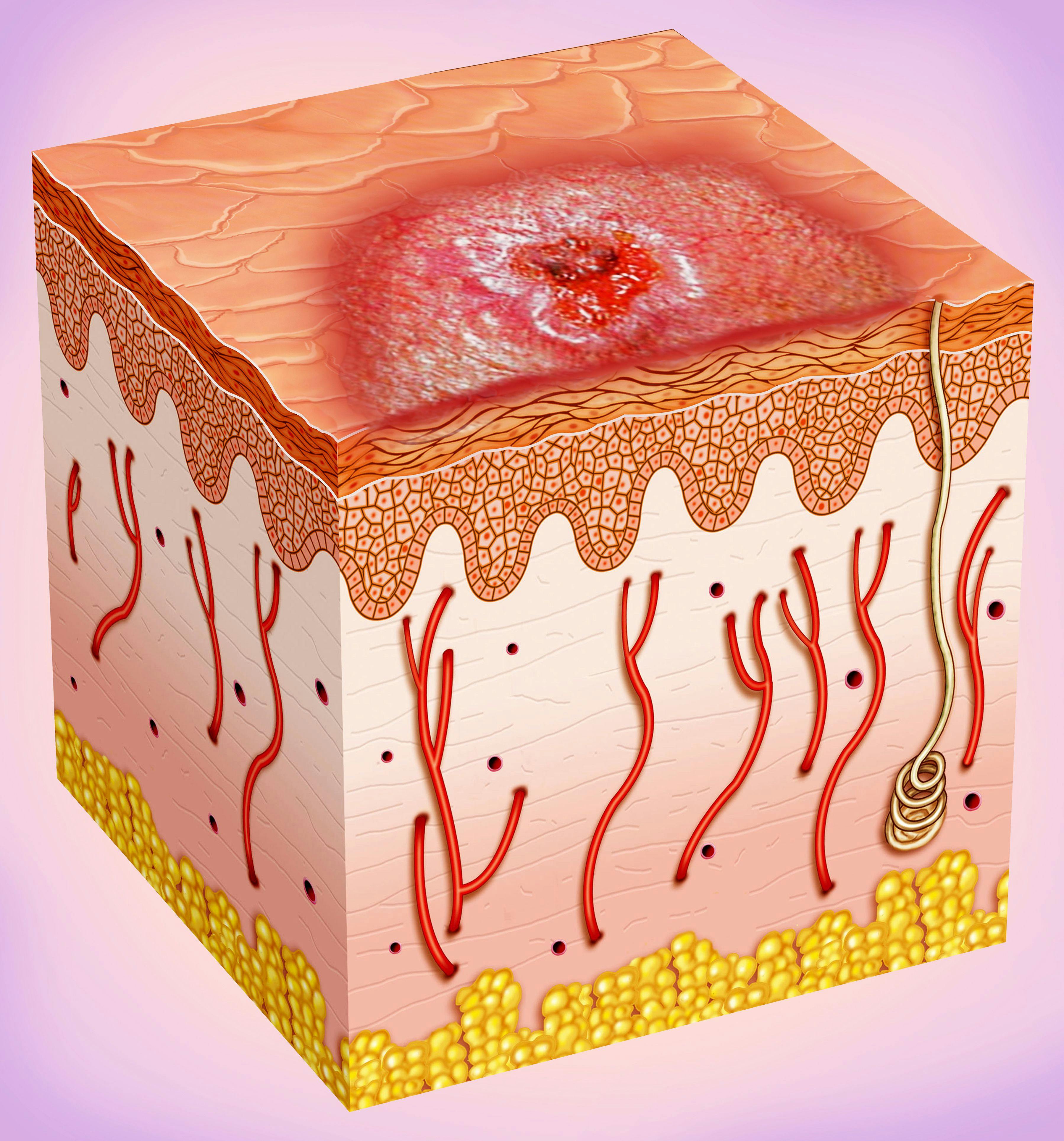 Basal cell carcinoma