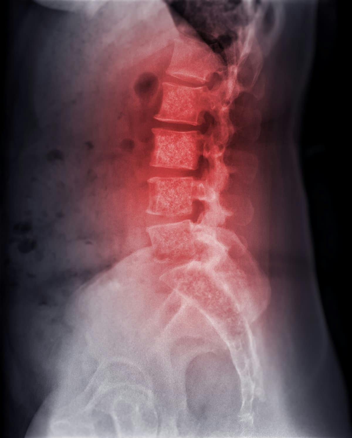 Stereotactic Radiosurgery Does Not Reduce Pain Vs EBRT in Vertebral Metastases | Image Credit: © samunella - stock.adobe.com.