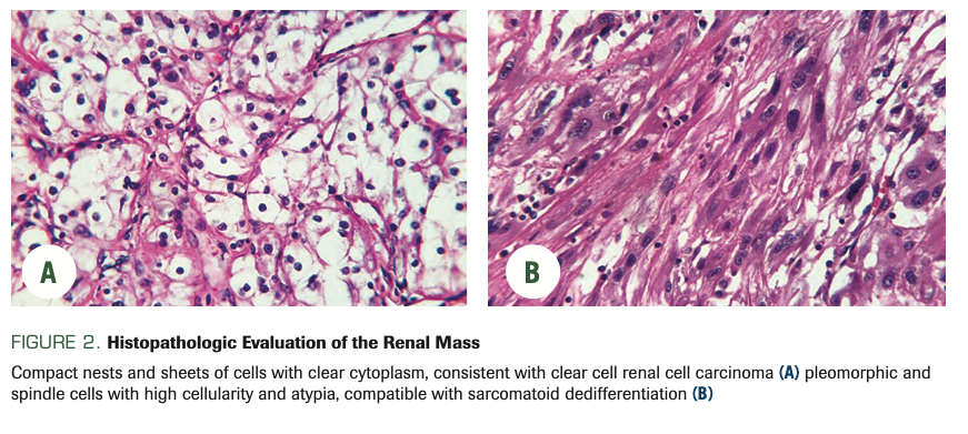 FIGURE 2. Histopathologic Evaluation of the Renal Mass
Compact nests and sheets of cells with clear cytoplasm, consistent with clear cell renal cell carcinoma (A) pleomorphic and spindle cells with high cellularity and atypia, compatible with sarcomatoid dedifferentiation (B)
