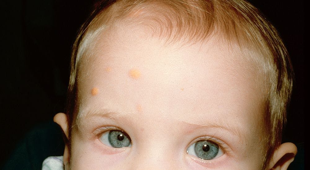 14-Month-Old With Multiple Dome-Shaped Yellow Papulonodules