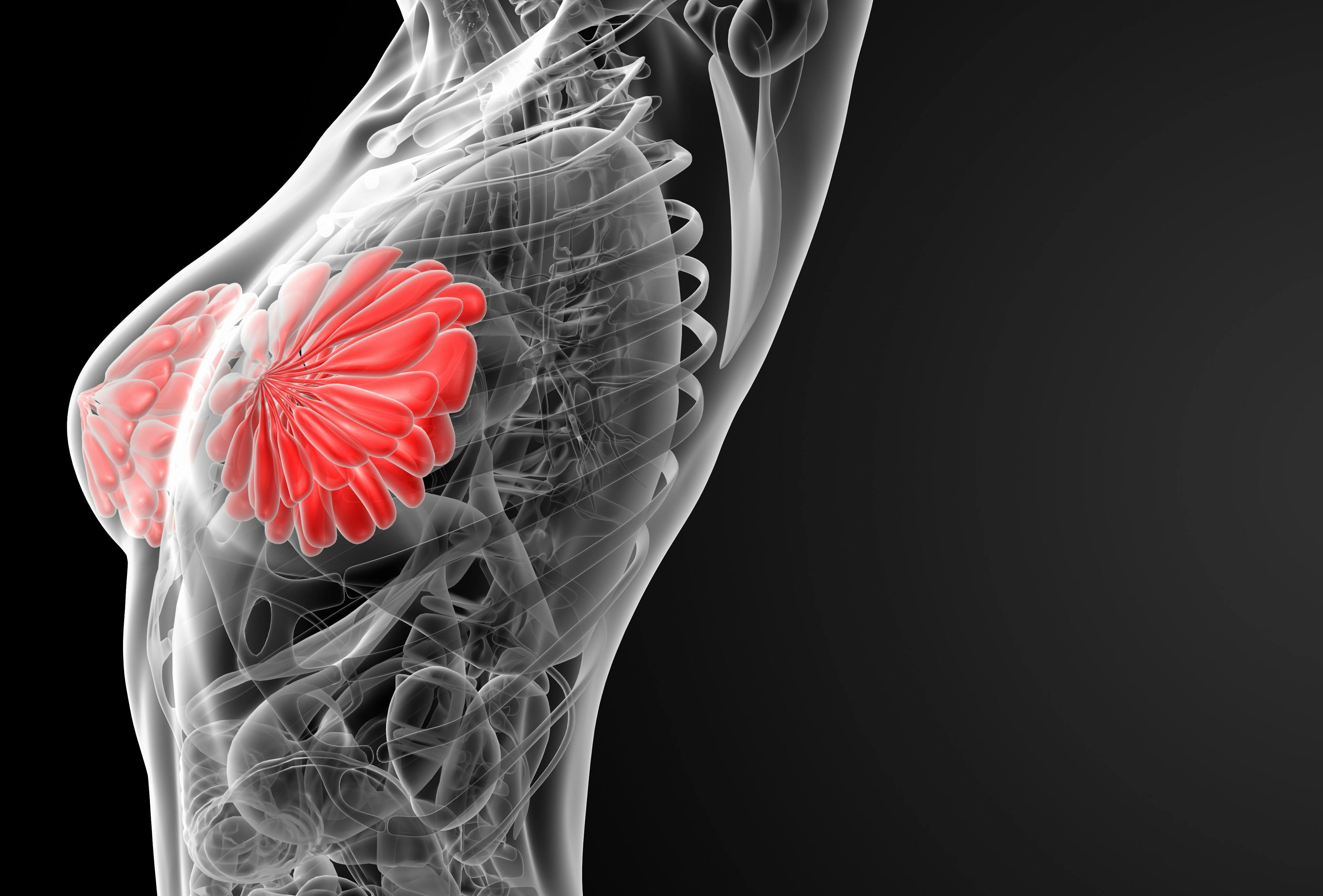 Breast cancer mortality could be reduced by half for patients with ATM, CHEK2, and PALB2 pathogenic variants who undergo annual MRI screenings between the ages of 30 to 35 years and annual MRI screenings and mammography for those 40 or older.