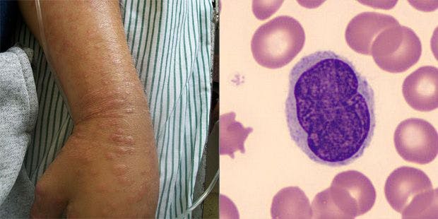 Extremely Pruritic Skin on 52-Year-Old Patient