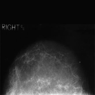 Mammogram showing normal fatty breast