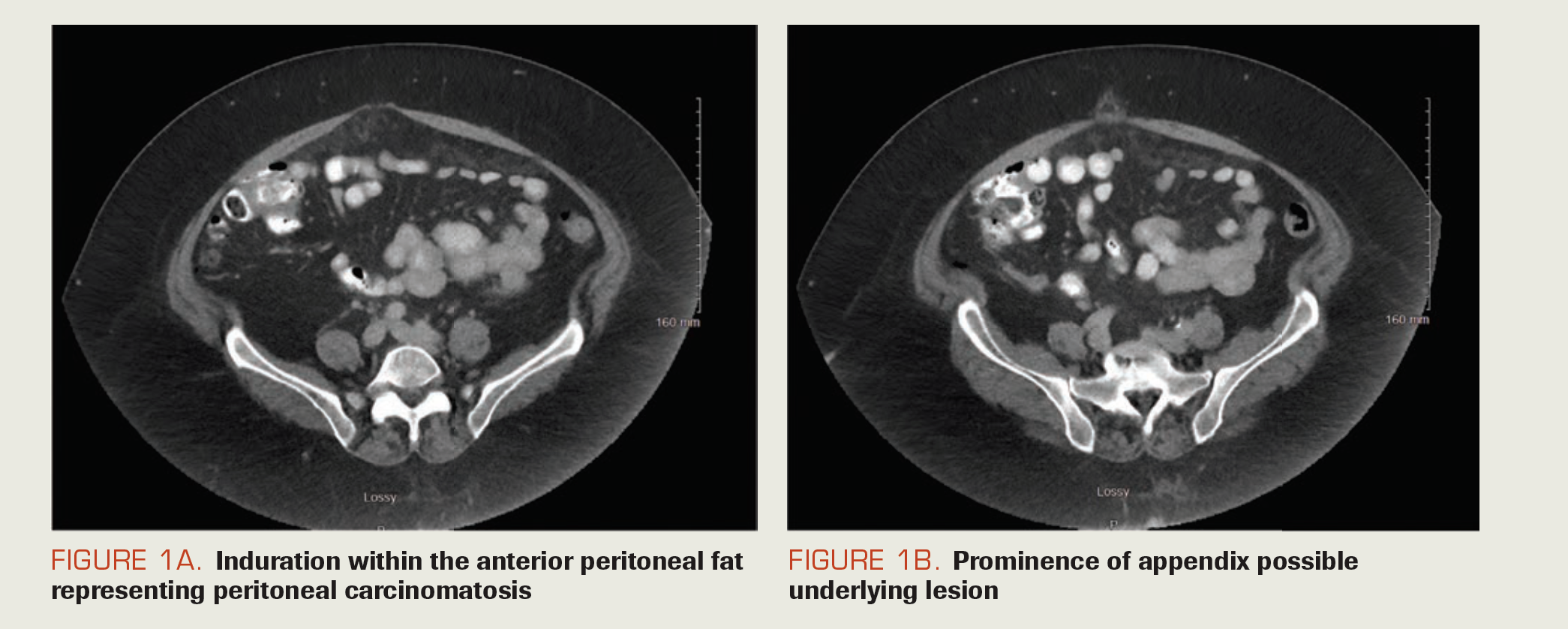 FIGURE 1A. Induration within the anterior peritoneal fat representing peritoneal carcinomatosis

FIGURE 1B. Prominence of appendix possible underlying lesion