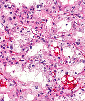 Micrograph of clear cell renal cell carcinoma