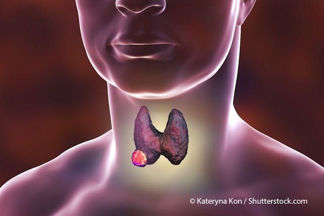 [18F]TFB PET/CT May Predict [18F]TFB/FDG Positivity in Differentiated Thyroid Cancer | Image Credit: © Kateryna Kon - shutterstock.com