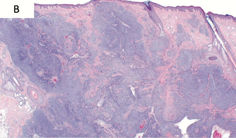 FIGURE 3. Histopathologic Features of Subsequent Metastases

(B) Representative sections of the supra-auricular scalp mass with diagnostic features of basal cell carcinoma (hematoxylin and eosin-stained tissue sections, original magnification × 40).