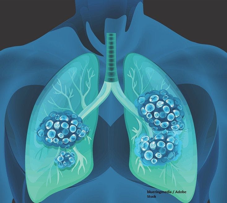 Cemiplimab/Chemo Receives Canadian Approval in Advanced NSCLC | Image Credit: © blueringmedia - stock.adobe.com.