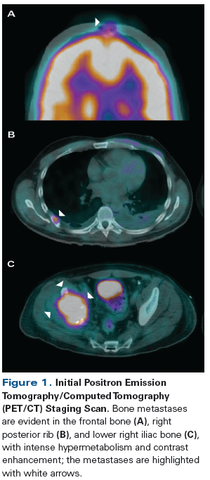 A Patient With Newly Diagnosed Metastatic Type 2 Papillary Renal Cell Carcinoma