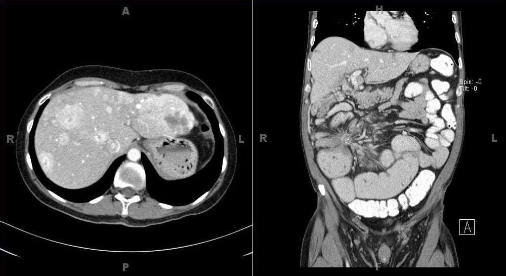 A 47-Year-Old Patient With Chronic Abdominal Pain
