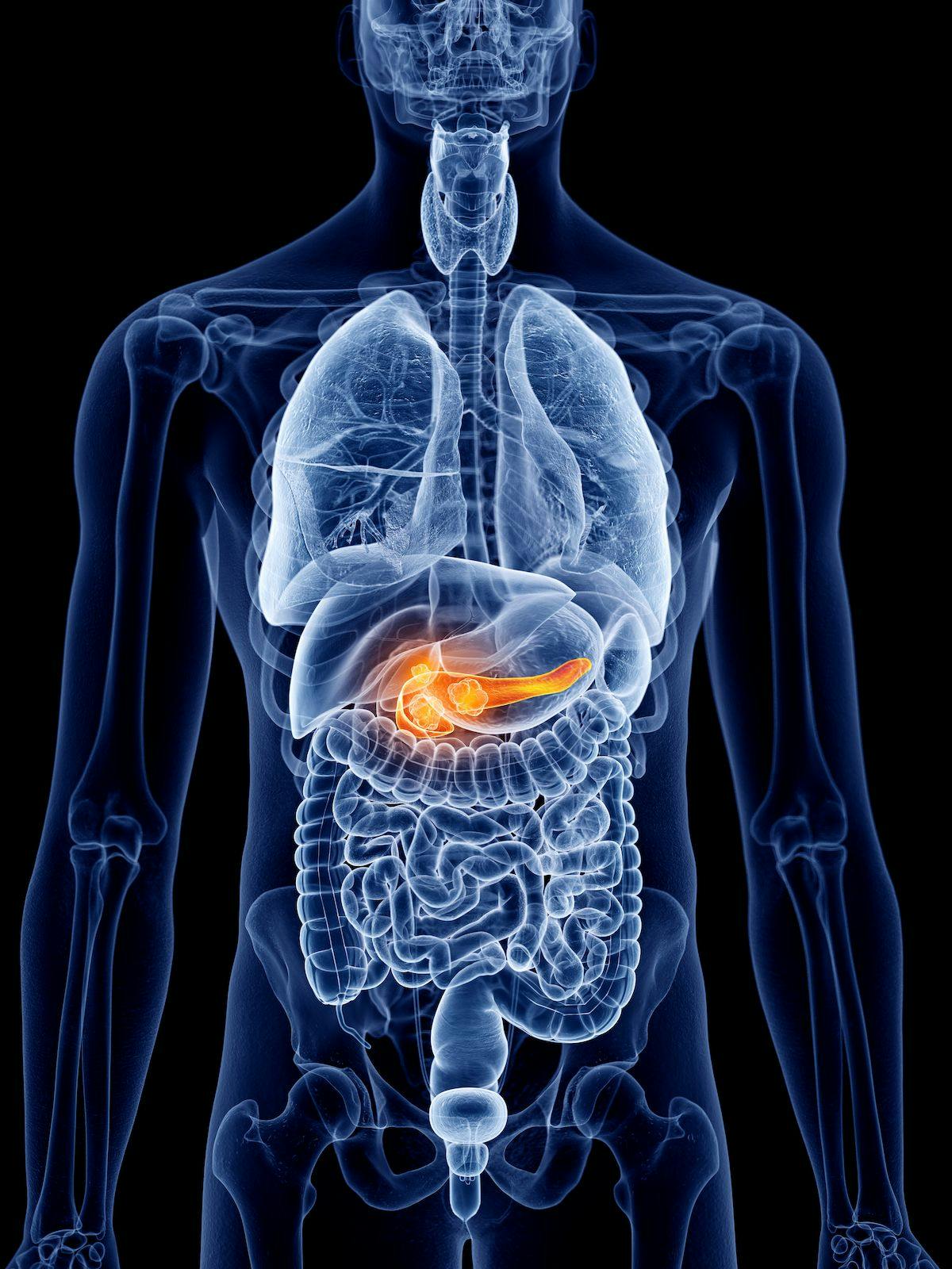Patients with pancreatic cancer may benefit from treatment with ATG-101, which was granted orphan drug designation by the FDA.