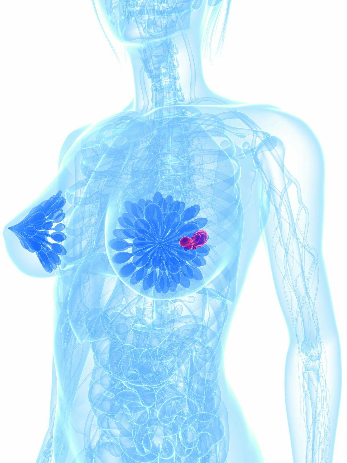 Patients with HER2-positive breast cancer and triple-negative breast cancer may not require breast surgery if a pathological complete response can be identified using image-guided vacuum core biopsy following neoadjuvant systemic therapy.